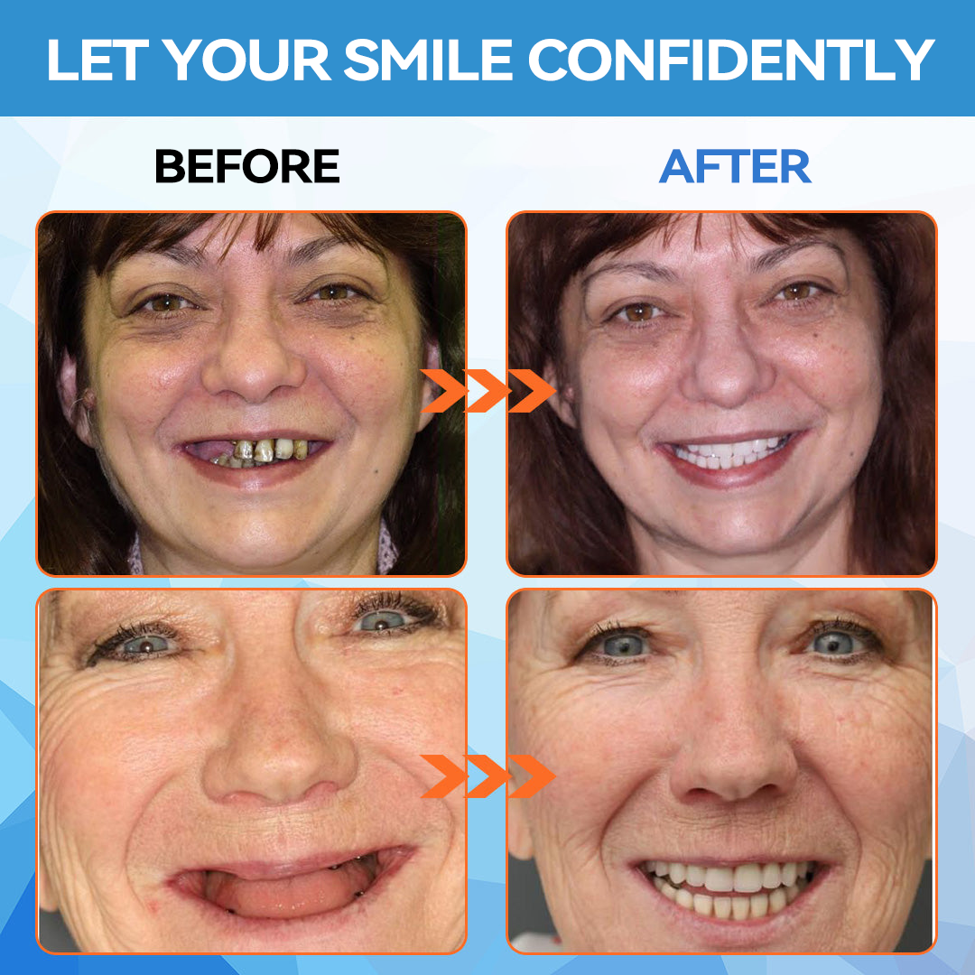 KLENIMORE™ 🦷  Silicone Reline Denture Set (⏰Limited Time 80% Off - Last 30 Minutes ⏰)