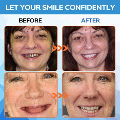 KLENIMORE™ 🦷  Silicone Reline Denture Set (⏰Limited Time 80% Off - Last 30 Minutes ⏰)