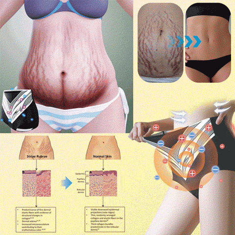 𝐀𝐝𝐯𝐚𝐧𝐜𝐞𝐝 𝐓𝐢𝐭𝐚𝐧𝐢𝐮𝐦 𝐒𝐡𝐚𝐩𝐢𝐧𝐠 𝐒𝐡𝐨𝐫𝐭𝐬 𝐰𝐢𝐭𝐡 𝐒𝐞𝐥𝐟-𝐇𝐞𝐚𝐭𝐢𝐧𝐠 𝐓𝐨𝐮𝐫𝐦𝐚𝐥𝐢𝐧𝐞 𝐓𝐡𝐞𝐫𝐚𝐩𝐲🎁🎁